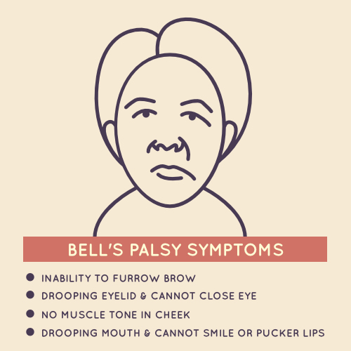 Bell's palsy symptoms
