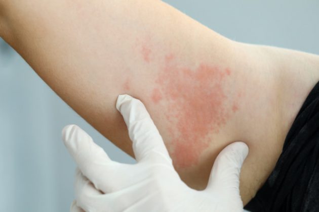 Common Adult Skin Rashes Symptoms Causes And Treatment