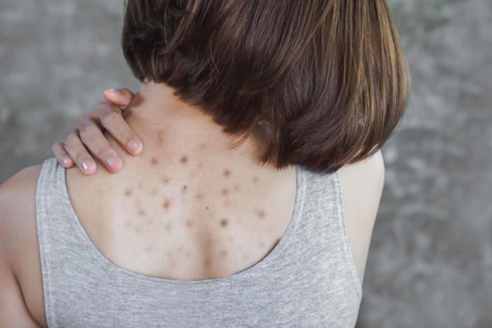 Asian woman having acne , dark and red spots on her back