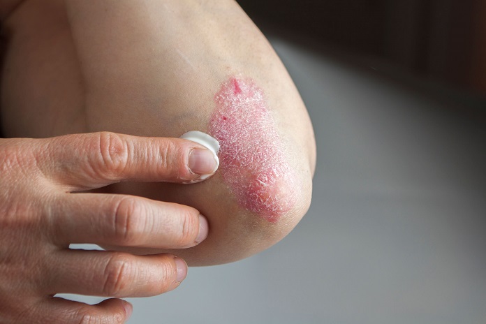psoriasis flare up in summer