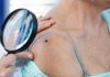early signs of skin cancer