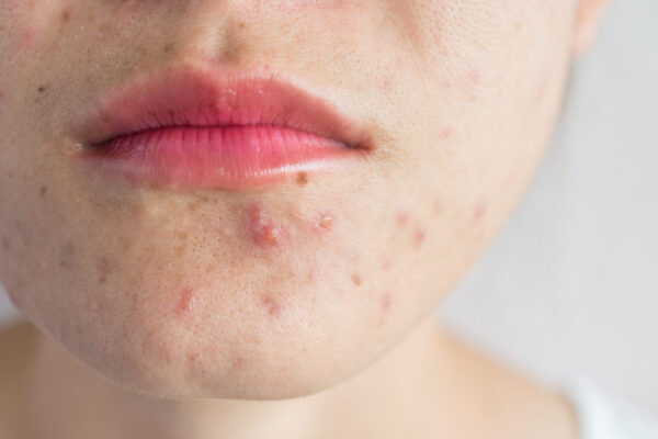 Does stress cause acne – and other acne causes | Wise Living