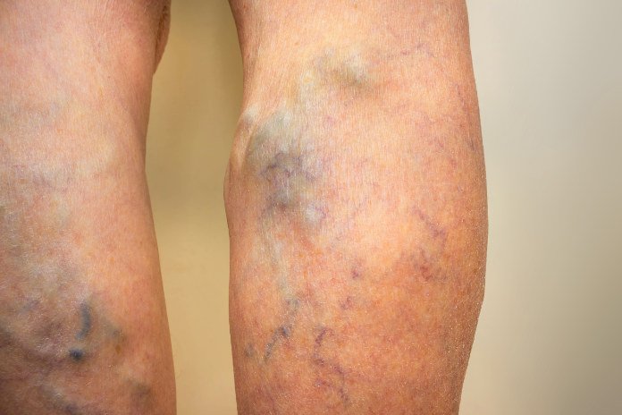 Varicose veins on a female senior leg close up