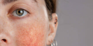 What is rosacea – woman with rosacea on her cheeks.