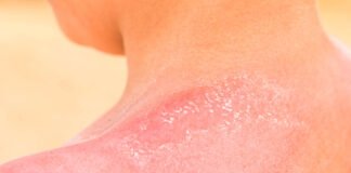 sunburnt skin A close up childs shoulder with red sun burnt peeling off skin.