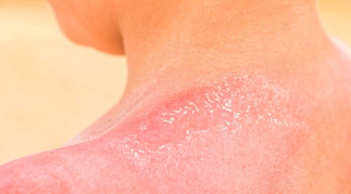 sunburnt skin A close up childs shoulder with red sun burnt peeling off skin.