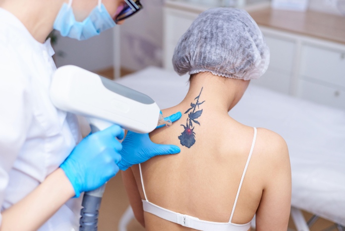 Does laser tattoo removal hurt? tattoo removal in a laser cosmetology clinic