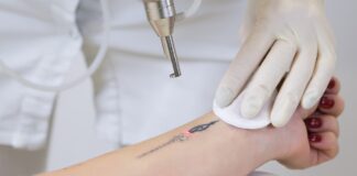 how does laser tattoo removal work